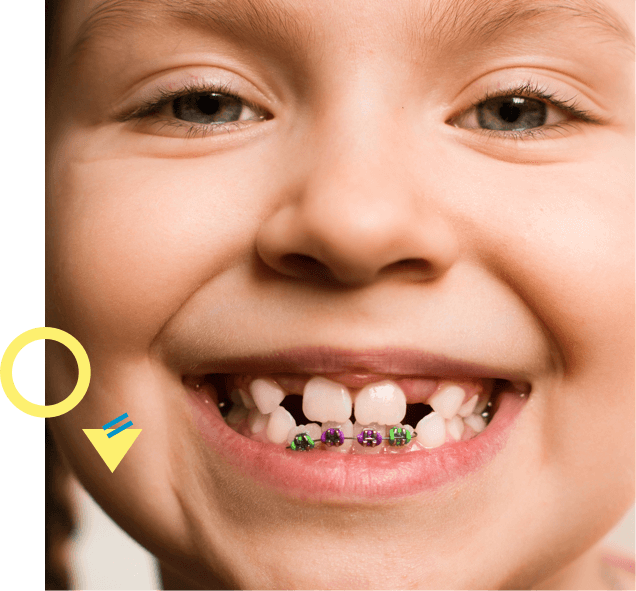child with braces