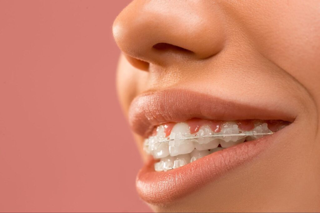How to Care for Your Teeth After Braces