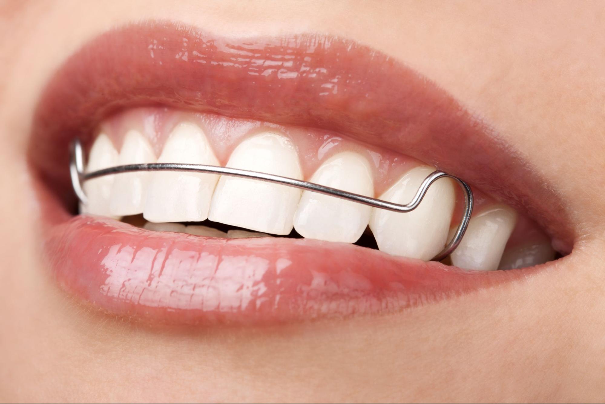 What Should I Do if I Lose or Damage My Retainers?
